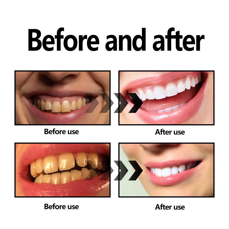 歯のホワイトニングパウダー チャコール/重曹歯のホワイトニン - Teeth Whitening Charcoal のレビューと価格